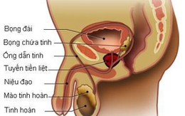 Sóng siêu âm diệt ung thư tuyến tiền liệt 