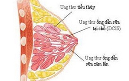 Các sản phẩm tẩy rửa làm tăng nguy cơ ung thư vú