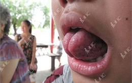 Cậu bé có chiếc "lưỡi rắn" kỳ lạ
