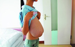 Thiếu nữ có bộ ngực nặng 8kg