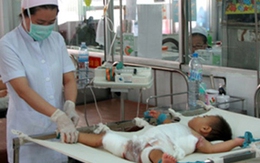 Tai hại vì sơ cứu sai khi bị bỏng
