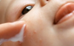 Cách chống muỗi đốt hiệu quả