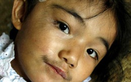 "Người khỉ" 5 tuổi