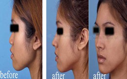 Đua nhau sửa mũi... "đổi vận"