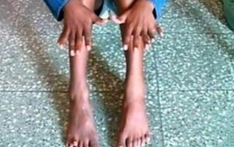 Bé 10 tuổi có 25 ngón chân, ngón tay