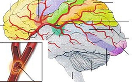 TP Hồ Chí Minh: Gia tăng bệnh nhân xuất huyết não