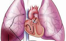 Kỹ thuật mới chữa bệnh phổi do máu đông