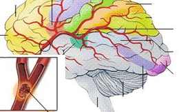 Xuất huyết não tấn công người trẻ