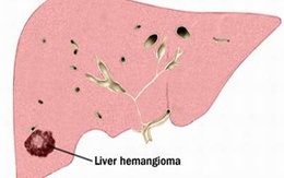 U máu trong gan: U lành hay u ác?