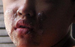 Học sinh lớp 6 bỏng nặng khi biểu diễn “kỳ lân phun lửa”