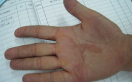 Hải Phòng: Xuất hiện bệnh giun bò dưới da 