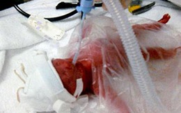 Cứu bé sinh non bằng túi đựng bánh