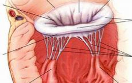 Nguy hiểm từ bệnh thấp tim