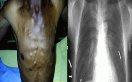 Nhiễm ấu trùng sán lợn do ăn thịt chưa chín kỹ