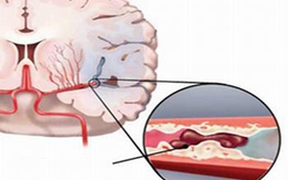 Cảnh giác với cơn thiếu máu não