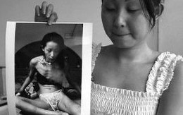 Ảnh gây sốc của thiếu nữ bị nghiện