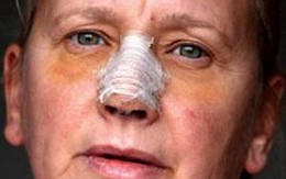 Gãy mũi vì 35 năm làm nghề cắt tóc