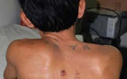Rút đinh tự găm vào cơ thể sau 20 năm