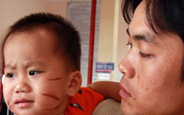 Hành hạ bé 20 tháng tuổi bằng sắt nóng