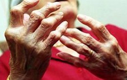 Tàn phế vì cứng khớp buổi sáng