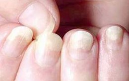 Các dấu hiệu trên móng tay cần lưu ý