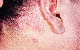 Giảm thọ vì mắc vảy nến da đầu