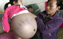 Nỗi khổ của bé gái 4 tuổi mang "bụng bầu"