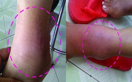 Cảnh giác với bệnh “lạ mà quen”