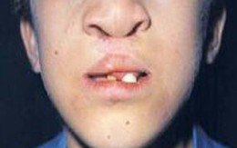 Chàng sinh viên mắc bệnh răng nhọn, tóc thưa