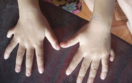 Quảng Nam: Bé gái có 24 ngón chân, tay