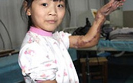 Bé gái 9 tuổi được ghép tay vào chân