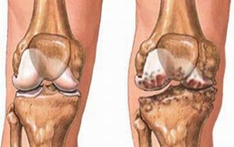 Cách giảm đau khớp không cần thuốc 