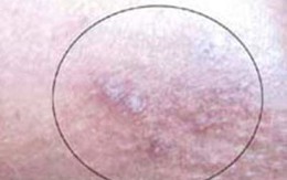 Côn trùng đốt người ở Huế là loài mạt