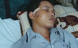 Vỡ xương gò má vì vướng vào… “mạng nhện”