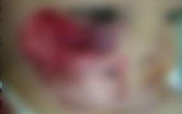 Cứu bé 23 tháng tuổi bị chó cắn nát mặt