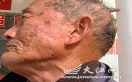 Ông lão 80 mọc sừng trên đầu