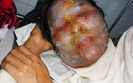 Chồng hắt chảo mỡ sôi vào mặt vợ