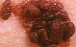 3 tuổi bị u ác tính di căn 