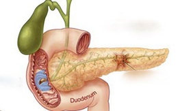 Phát hiện cách ngăn ung thư tụy giai đoạn đầu
