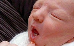 Vừa chào đời đã có 2 răng hoàn chỉnh 