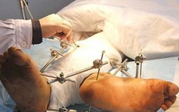 Người đàn ông có 2... chân phải