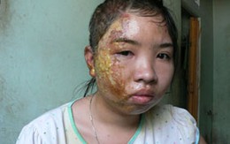 Dội nước sôi vào đầu con riêng của vợ