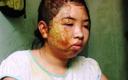 Thiếu nữ bị cha dượng dội nước sôi lên người ký đơn bãi nại