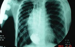 Gần 10 năm chán ăn vì chứng hẹp thực quản