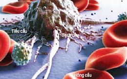Có phải mọi khối u đều là ung thư?