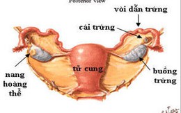 Phát hiện trễ, bé gái mất buồng trứng trái 