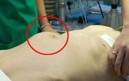 Cứu bệnh nhân phình động mạch chủ bụng