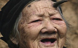 Sừng trên trán cụ bà 102 tuổi dài gấp đôi sau 1 năm