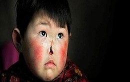 Bé gái bị vi khuẩn "ăn" mất mũi