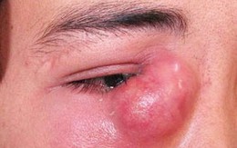 Chảy nước mắt nhiều coi chừng tắc lệ đạo